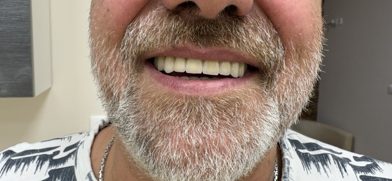 Ugyanez az implantátumokra készült felső körhíd a páciens mosolyában
